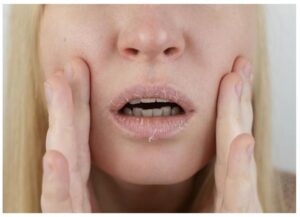 A middle-aged woman with occasional nosebleeds and dry mouth