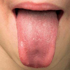 A 7-year-old male with pallor and abdominal discomfort