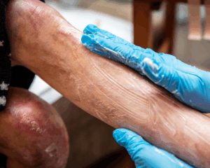 A middle-aged woman with unknown rash on lower extremities