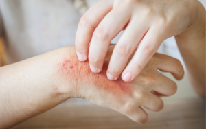FDA Approves Eli Lilly’s EBGLYSS as a Breakthrough Treatment for Moderate-to-Severe Eczema