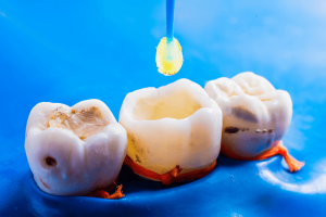 Biomimetic Mineralization Strategies Using Keratin Scaffolds to Restore Dental Enamel