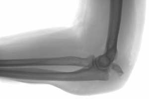 SCIENCE Study Reveals Non-Surgical Care Is Safer, Cheaper, and Effective for Kids’ Elbow Fractures